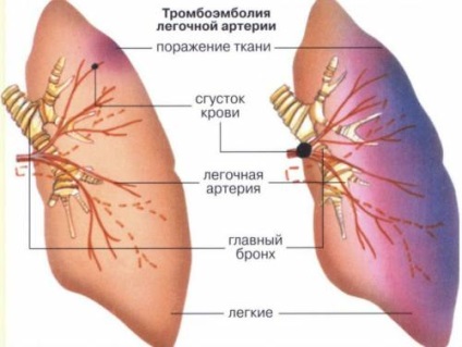 EKG tüdőembólia, tüdőembólia jelei