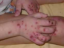 Ekcéma gyermekeknél a kéz és az ujjak tünetei és kezelése