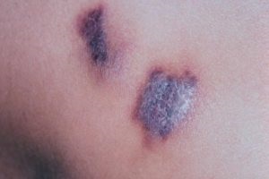 Фіолетові (сині) плями на шкірі що це таке, як лікувати