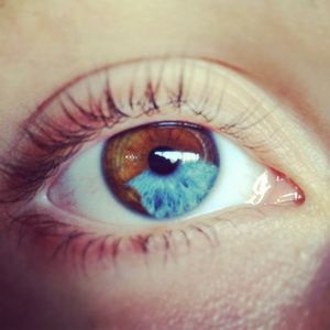 Részleges heterochromia heterochromia emberben okoz az, hogy lehet-e változtatni a szem színét