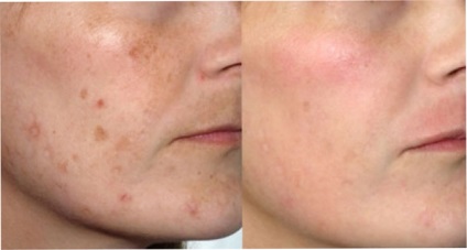 Hyperpigmentation hogyan lehet megszabadulni a probléma