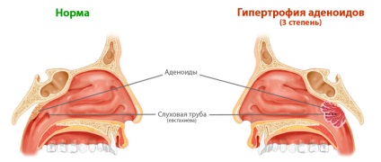 Hypertrophia limfoid szövet hátsó orrgarat felnőttekben