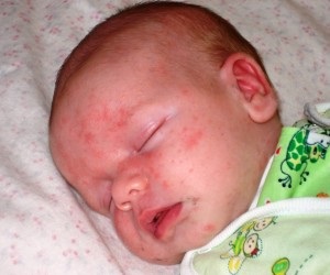 Pustules csecsemők mögöttes okok és kezelések