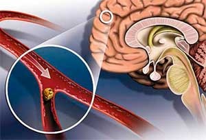 Brain ischaemiás stroke, okoz csökkentése és megelőzése