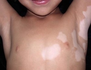 Komorowski okairól és a vitiligo kezelésére gyermekeknél, és a kezdeti szakaszban a fotó