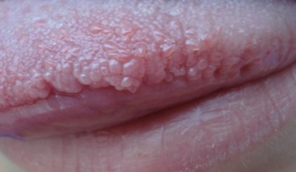 Condylomata száj kép okoz eltávolítását, bőrbetegségek