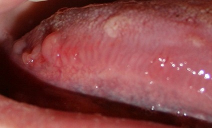 condyloma száj a sertés fonálféreg kezelése