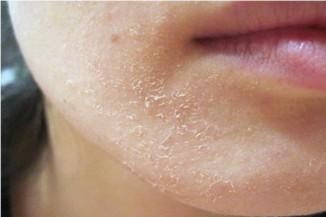 miért vannak vörös foltok az arcon és hámlik hajdina pikkelysömör kezelése