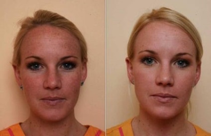 Krioterápia arc véleménye, fotók előtt és után
