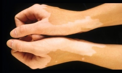 A kezelés a vitiligo népi jogorvoslati