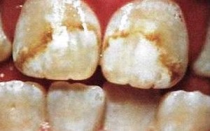 A fogak voltak fehér foltok okoz, kezelési módszerek, fotók