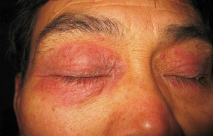 atópiás dermatitis szem)