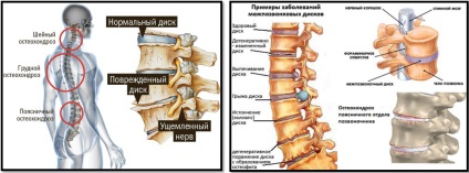 Osteochondrosis és testépítés