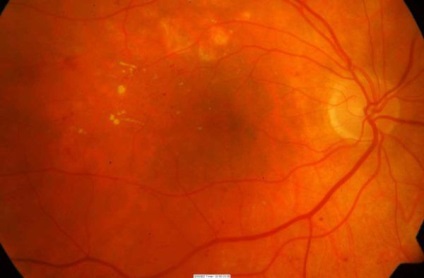 retinális ödéma okai és kezelése a szem