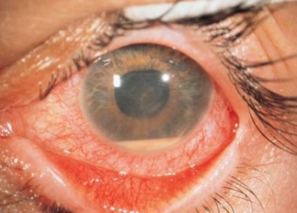 retinális ödéma okoz a szem, a tünetek és a kezelés a betegség