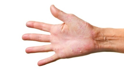 Miért száraz bőr (a kéz, arc, test)