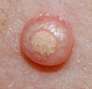 Pattanások a péniszt, amely betegségek megnyilvánulhat akne
