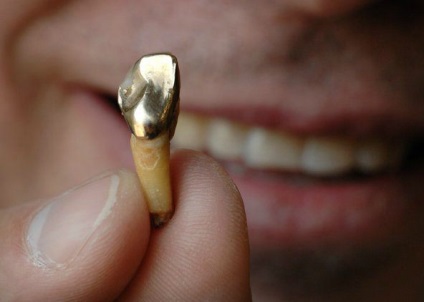 Protézis hiányában számos fajta fogak