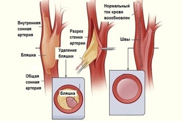 Tünetei alsó végtag arterioszklerózis és időben történő kezelés