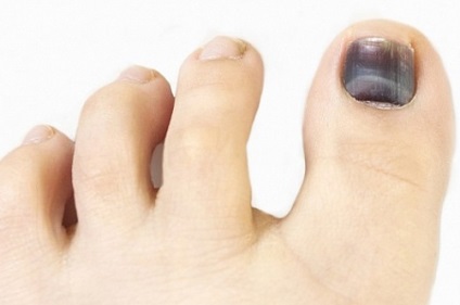 zúzódás a köröm alatt vagy gomba a kezelés nail gombák ecetsav