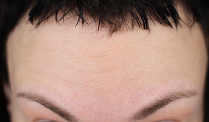 Azt jelenti, tűk nem több t Botox már nincs szükség (Botox) Azt jelenti, tűk többé t Botox már nincs szükség