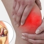 Injekciók arthritis ízületi gyulladás kezelésére alkalmas
