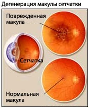 Вікова дегенерація сітківки ока - медичний портал eurolab
