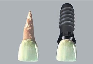 Alpha Bio implantátum előnye és hátránya az épületek (építmények) Alpha Bio implantátumok előnyeiről és hátrányairól szerkezetek