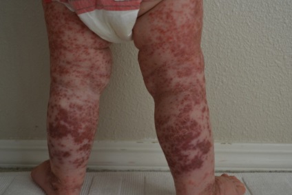 Allergiás bőrkiütés, hogyan kell harcolni