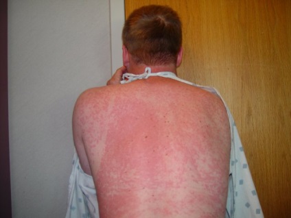 Allergiás bőrkiütés, hogyan kell harcolni