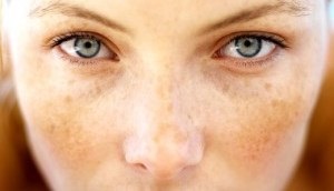 Allergia Arc bőrtünetek - arc, homlok, áll