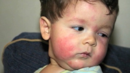 Allergia méz gyermekeknél okoz, tünetei, kezelés, megelőzés