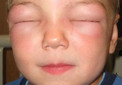 Allergia méz gyermekeknél okoz, tünetei, kezelés, megelőzés