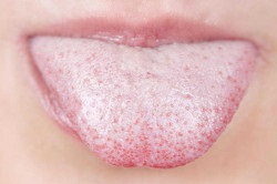 Allergia nyelvi okai, tünetei és kezelése