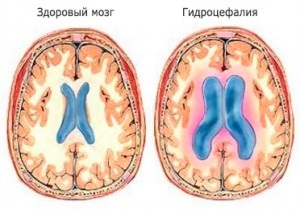 Aszimmetrikus hydrocephalus és tünetei