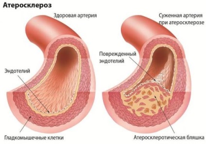 atherosclerosis az alsó végtagok a cukorbetegség kezelésének)