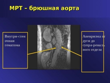 atherosclerosis a vaszkuláris az alsó végtagok kezelésére során cukorbetegség