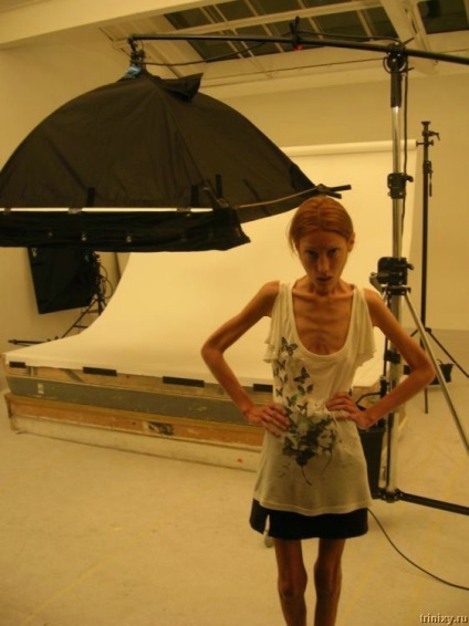 anorexia betegség (60 fotó) - triniksi