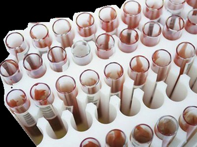 Narancsbőr és a hormonok - klinikai egészségügyi és szépségápolási eco (cellulitis) Narancsbőr és a hormonok - klinikai egészségügyi és szépségápolási eco