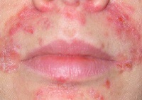 Dermatitis az arcon felnőtteknél okoz és kezelés