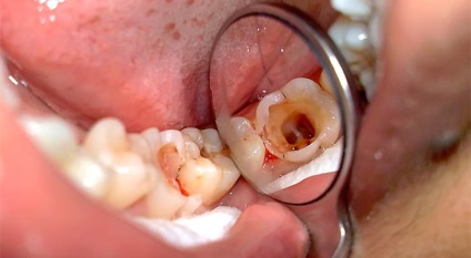 Gangliitis - neuralgia pterigopalatális csomópont okok, tünetek, kezelés, prognózis