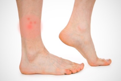 Herpes lábon kép, tünetek és kezelések