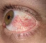 Kötőszöveti vérbőséget - tünetek és kezelés a moszkvai Eye Clinic