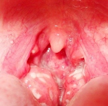 Gennyes mandulagyulladás fotó, tünetei, hogyan kell kezelni gennyes mandulagyulladás
