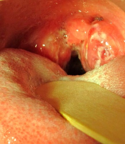 Gennyes mandulagyulladás, mint amilyennek látszik, tünetei és kezelése