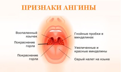 A prosztatitis és a mandulagyulladás kommunikációja