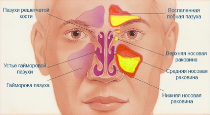 Gennyes sinusitis tünetek és a kezelés