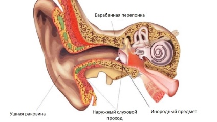 Egy idegen test a fülben és eltávolítjuk a tünetek érezhetők