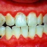 Hogyan lehet eltávolítani a fogkövet súlyos parodontosist - szike - Orvosi