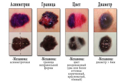 Mi a kezdeti szakaszban a melanoma fotót különböző